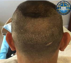 Hair transplant on scar treatment