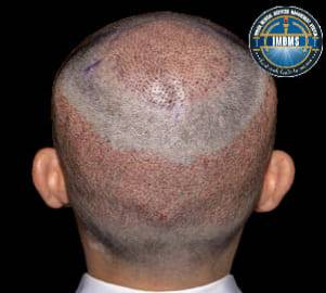 Hair transplant advanced FUE European technology treatment
