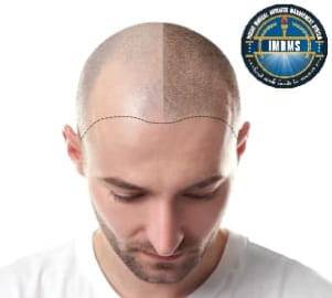 Scalp Hair Transplant treatment