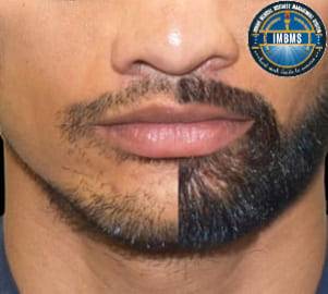 Mustache hair transplant treatment