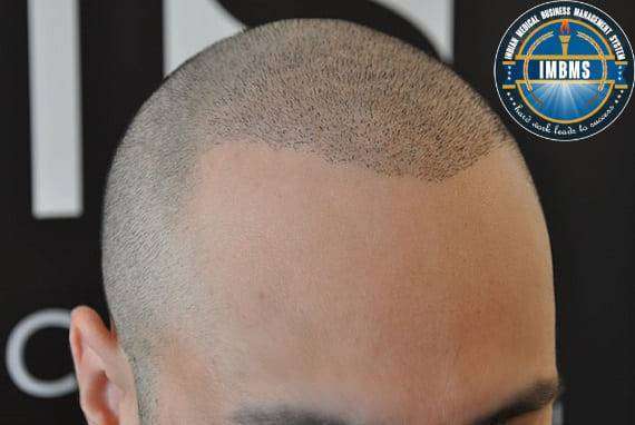 Hair transplant on scar treatment