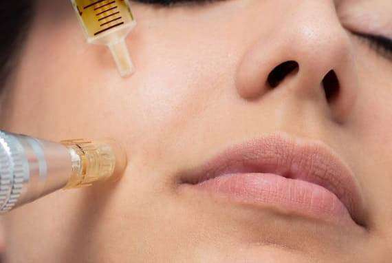Micro needling for anti ageing treatment