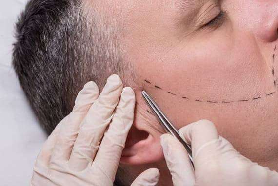 Beard hair transplant treatment